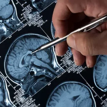 بهترین روش تشخیص آلزایمر