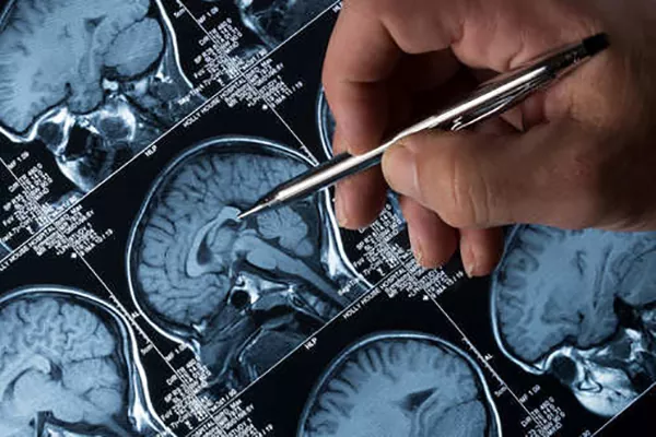 بهترین روش تشخیص آلزایمر