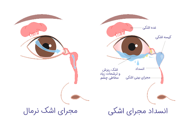 اسکن مجاری اشک