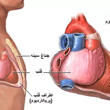 پریکاردیت