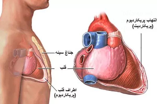 پریکاردیت